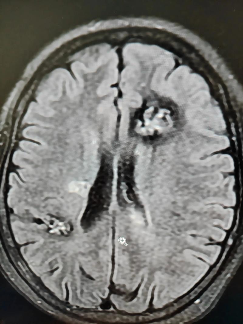 曾经脑梗会得脑血瘤吗