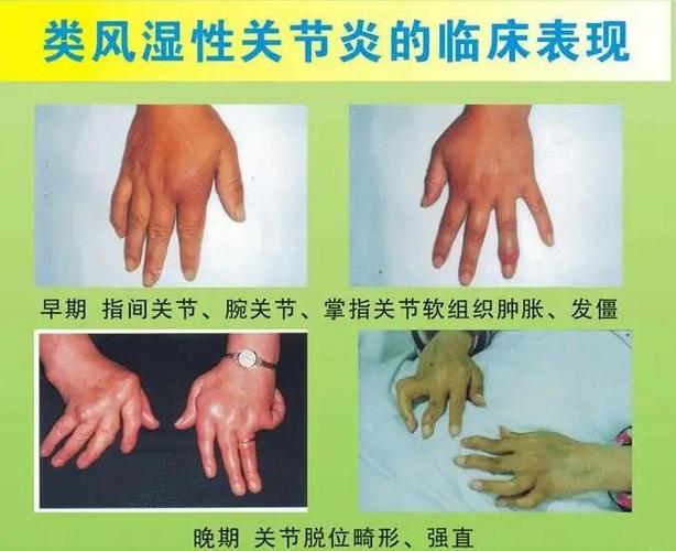 风湿因子阴性的类风湿