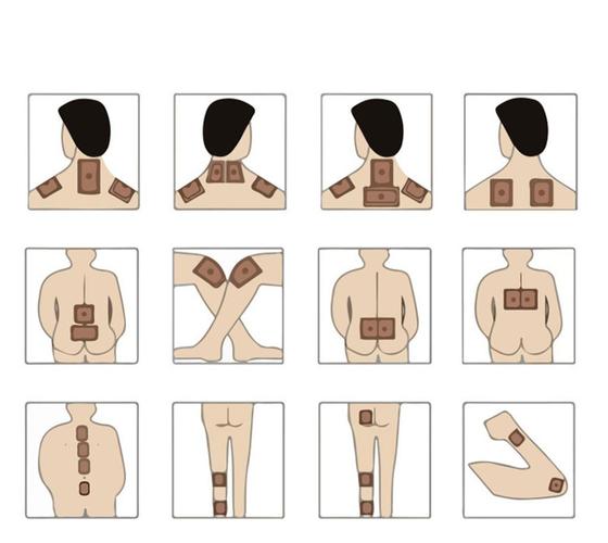 溢涌堂穴位贴敷治疗贴