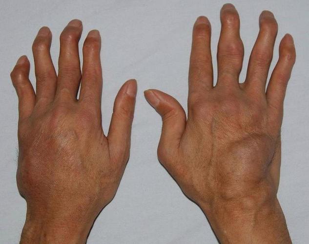 类风湿1005类风湿