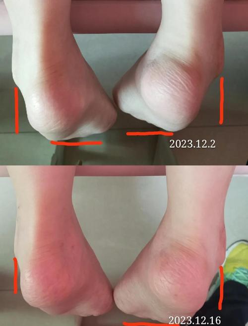 脑梗 双脚无力 恢复