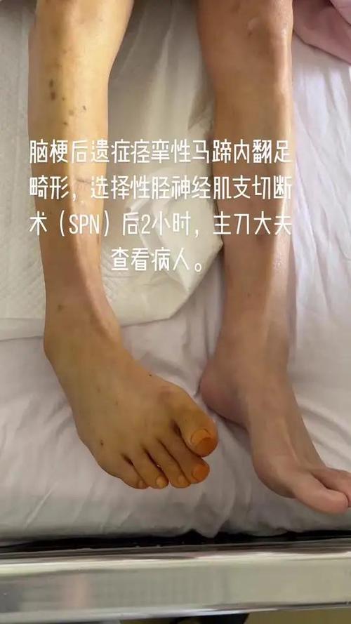 脑梗 双脚无力 恢复