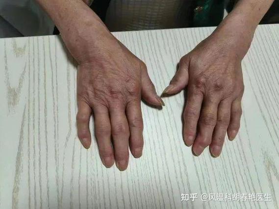 类风湿结节风湿结节吗