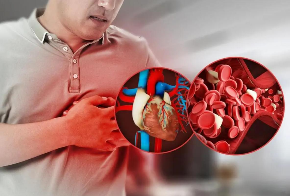 心梗病人会发生脑梗吗