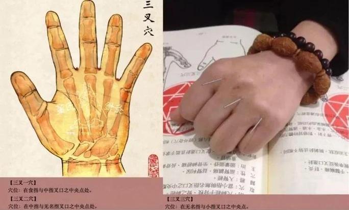 前列腺肥大的穴位治疗