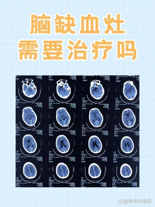 脑内多发缺血灶是脑梗