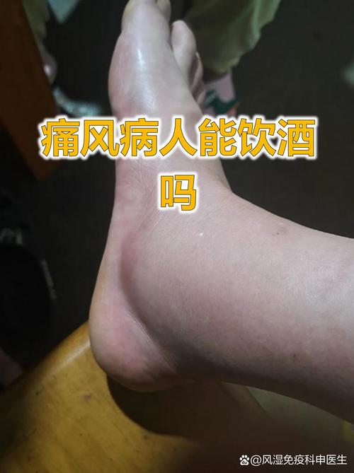 风湿和类风湿喝酒好吗