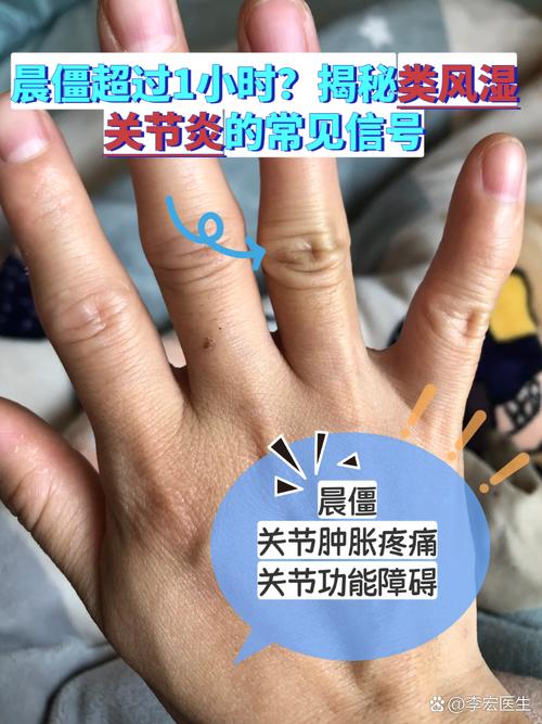 风湿类风湿的早期症状