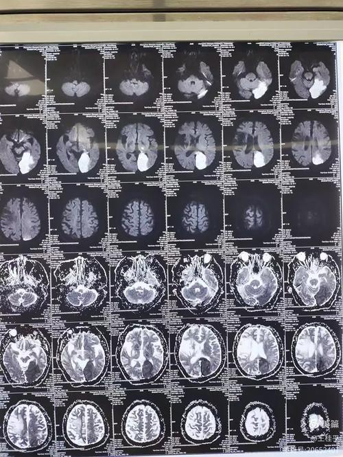 脑CT基底节左侧脑梗