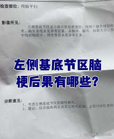 脑CT基底节左侧脑梗
