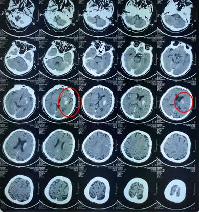 脑CT基底节左侧脑梗