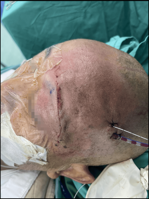 骨折手术 脑梗 复发