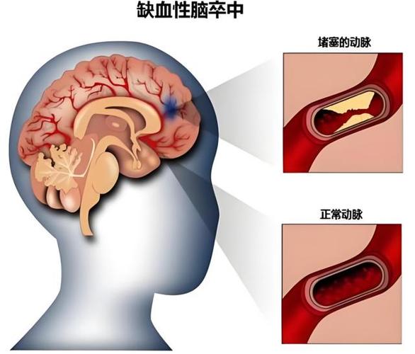 脑梗左脑右脑动脉堵压