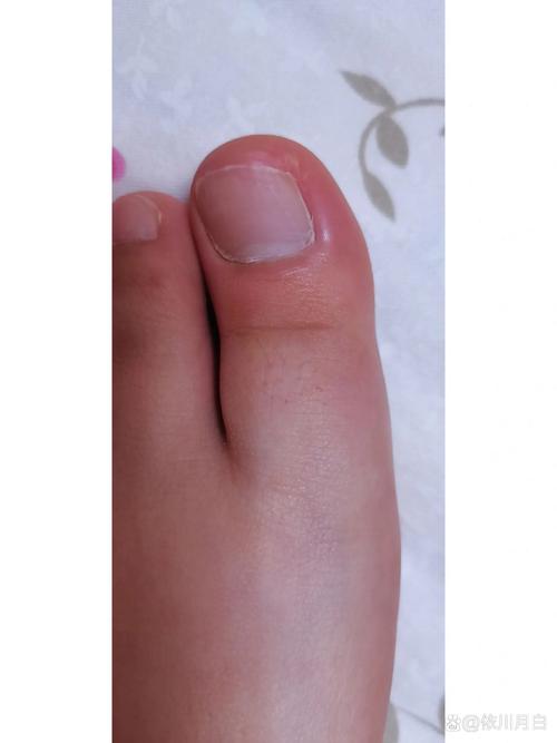 脑梗 卧床 脚趾 肿