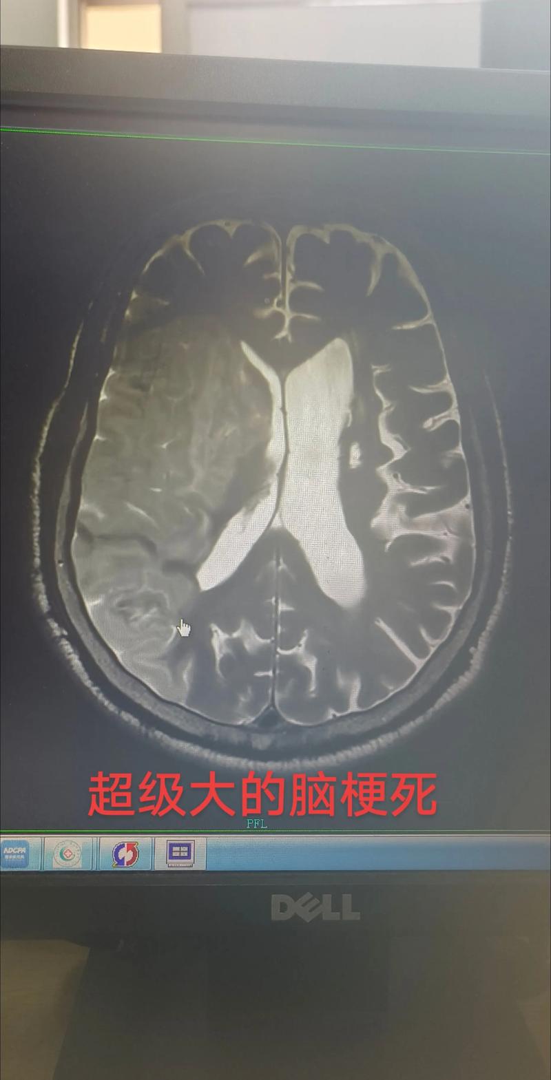 左脑大面积脑梗 发烧