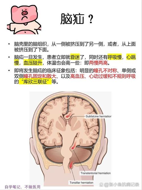 小脑脑梗会导致脑疝吗