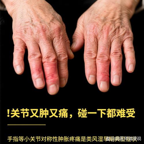 类风湿 风湿那样严重