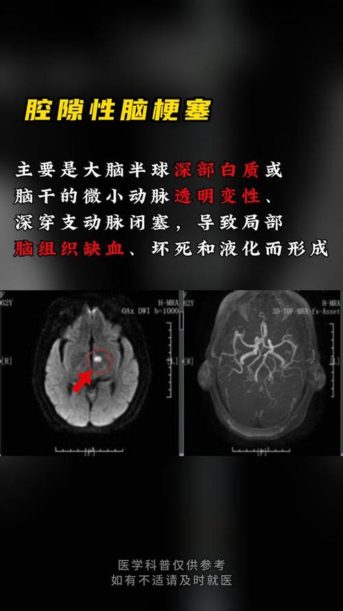 脑核磁能查出腔隙脑梗