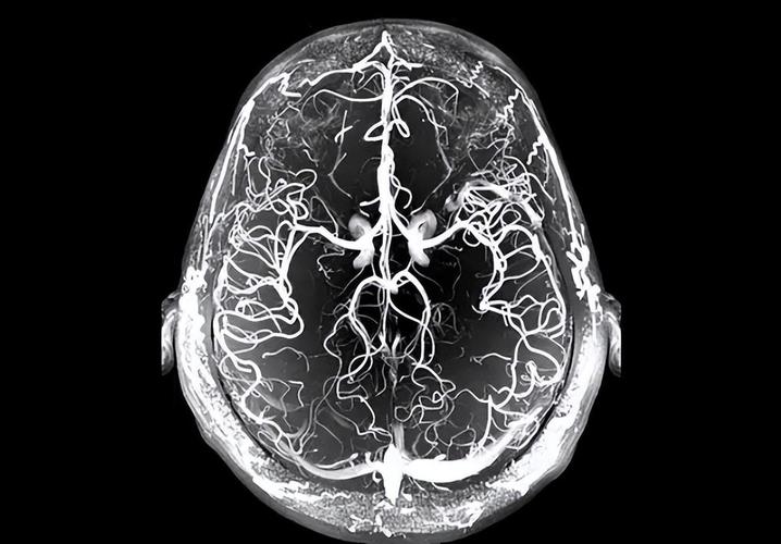 脑核磁能查出腔隙脑梗