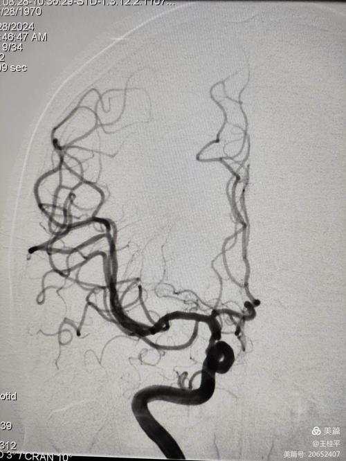 右侧脑动脉大面积脑梗