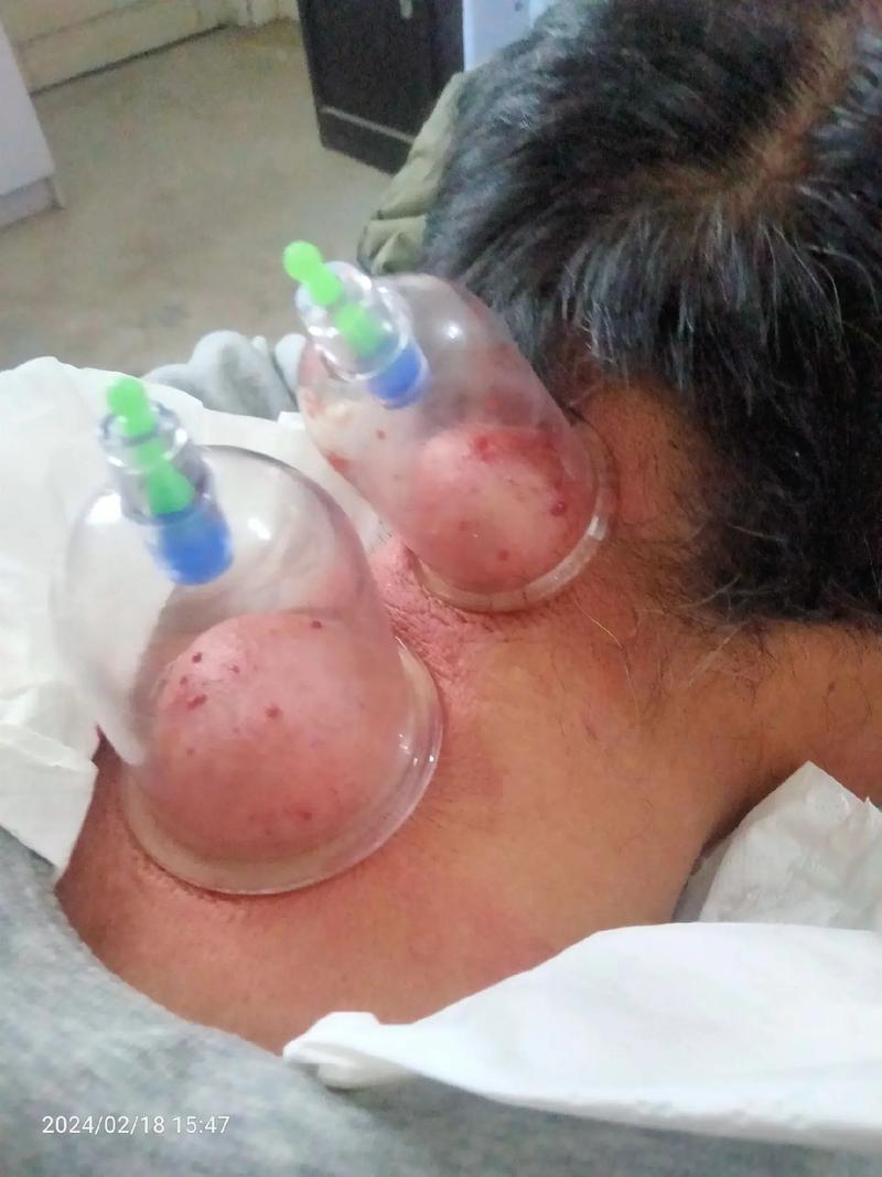 脑梗 脑块血拔罐好吗