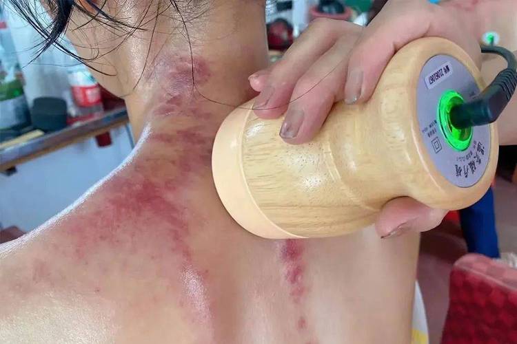 脑梗 脑块血拔罐好吗