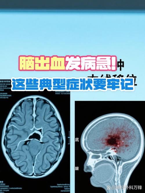 脑梗伴脑内多发微出血