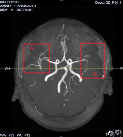 脑磁共振能查出脑梗吗