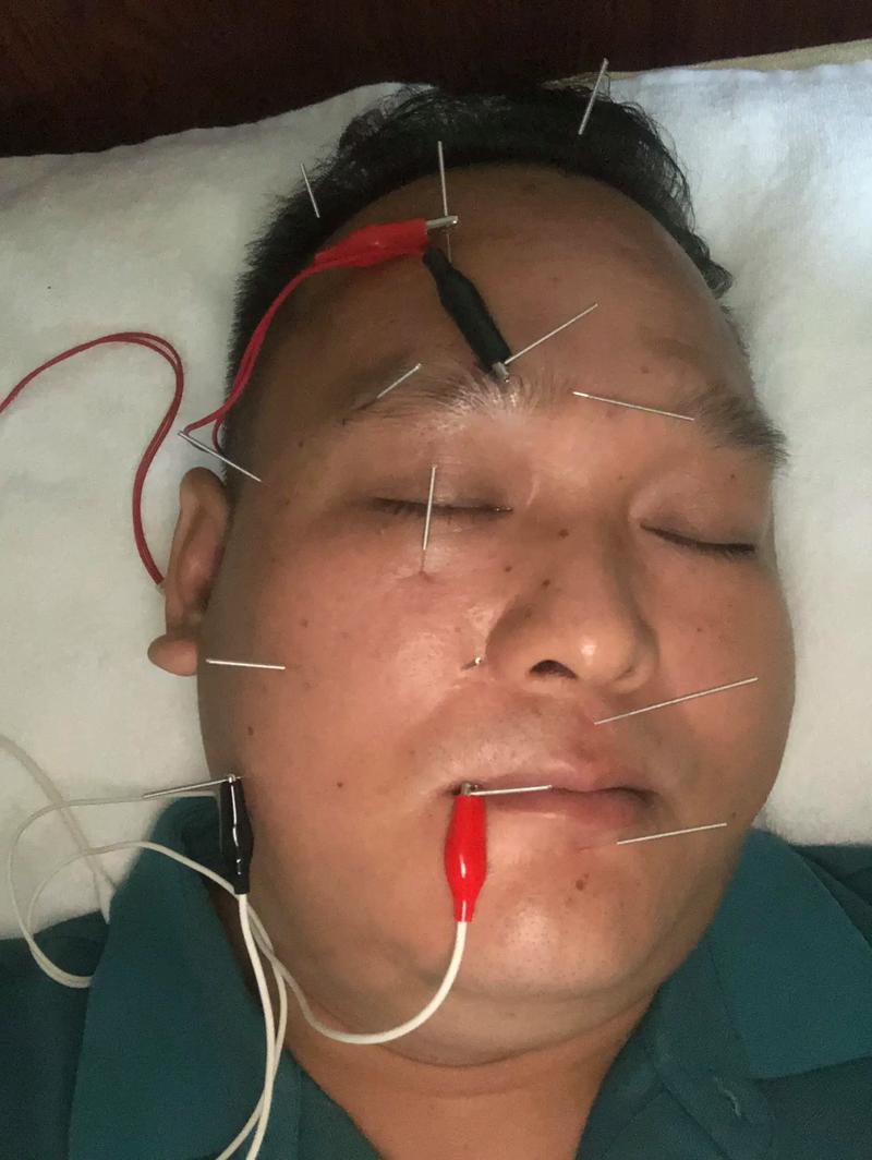 面神经麻痹的针灸穴位