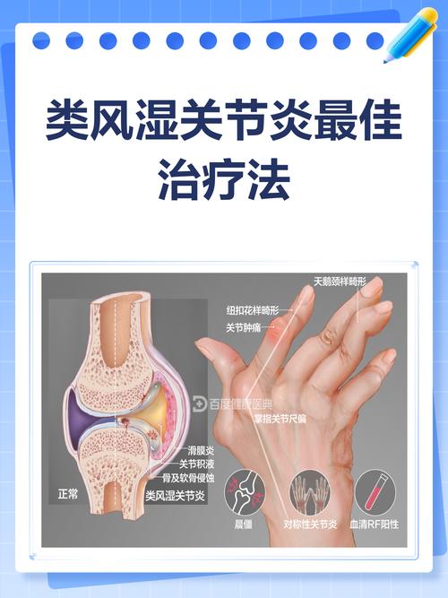 类风湿性关节炎治疗法