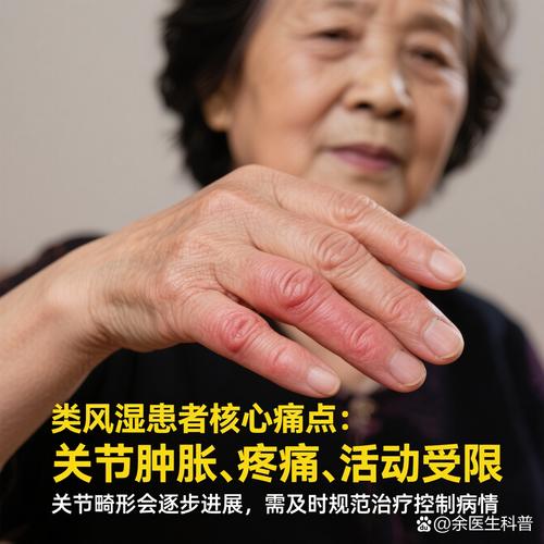 哺乳期类风湿性关节炎