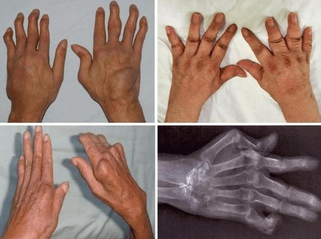 哺乳期类风湿性关节炎