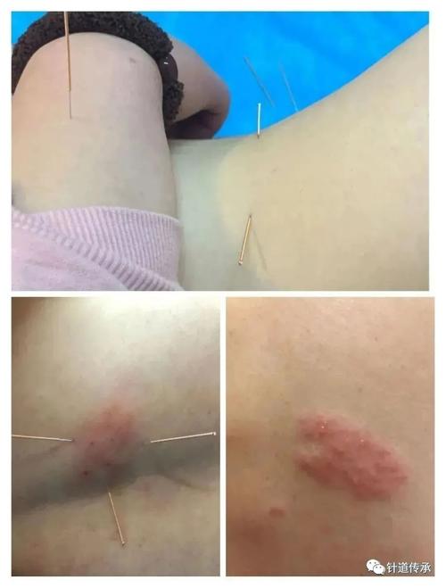 带状疱疹 针灸 穴位