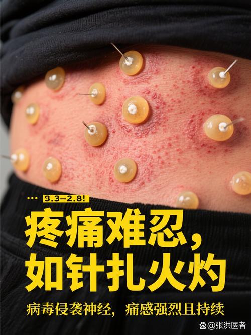 带状疱疹 针灸 穴位