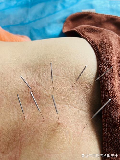 子宫下垂针灸什么穴位