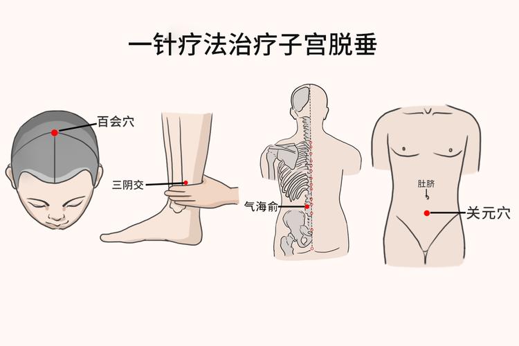 子宫下垂针灸什么穴位