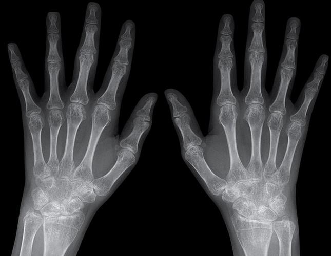 小孩有类风湿性关节炎