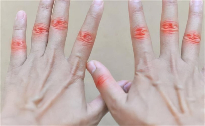 手指风湿 穴位 按摩