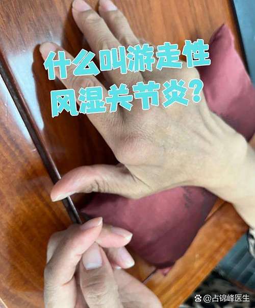 游走性类风湿性关节炎