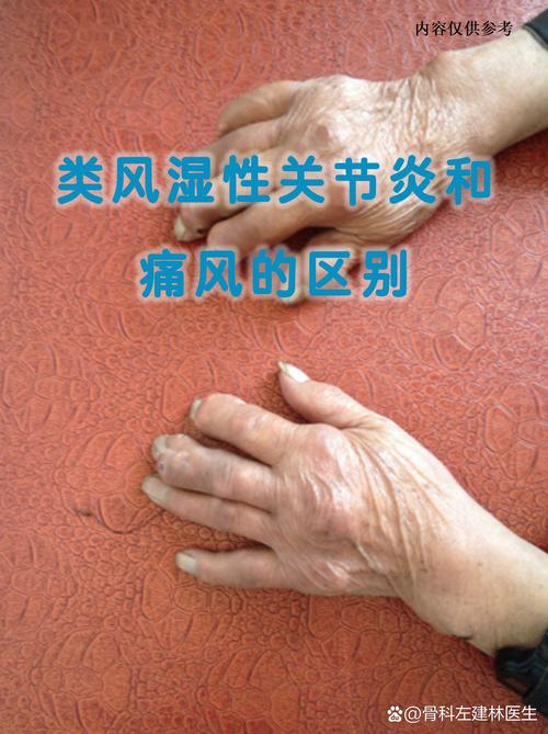 类风湿性关节炎活几年