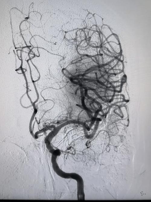 心脏cta检查 脑梗