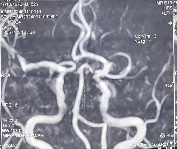 心脏cta检查 脑梗