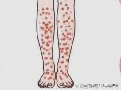 类风湿性关节炎血小板