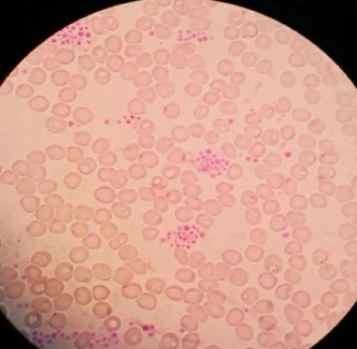 类风湿性关节炎血小板