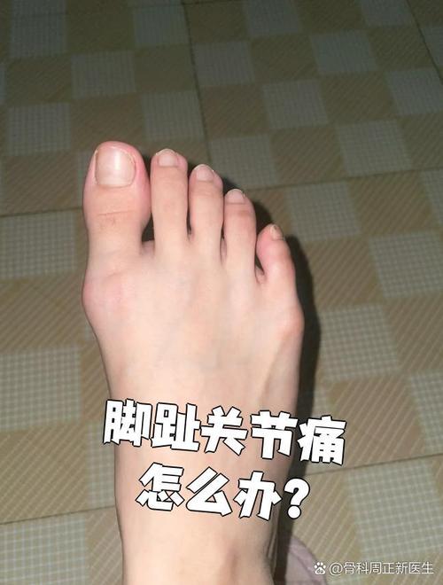 脚类风湿性关节炎图片