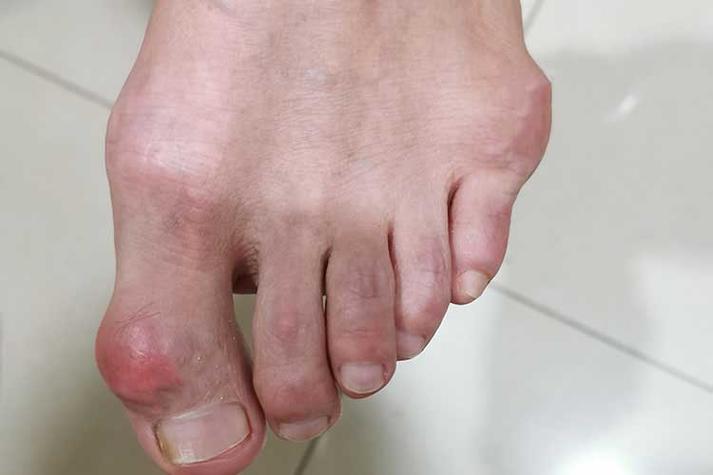 脚类风湿性关节炎图片