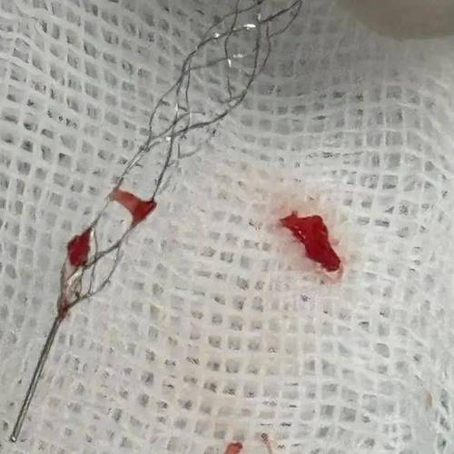 瑞金医院 脑梗 支架