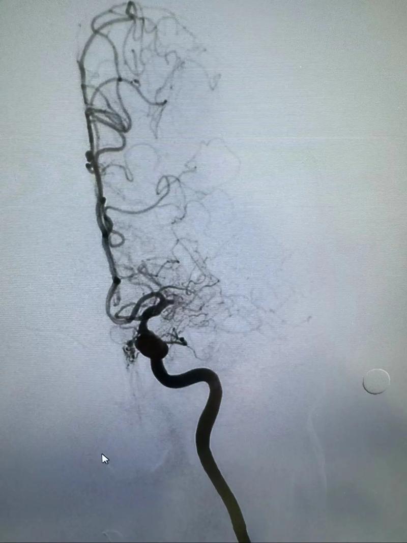 瑞金医院 脑梗 支架
