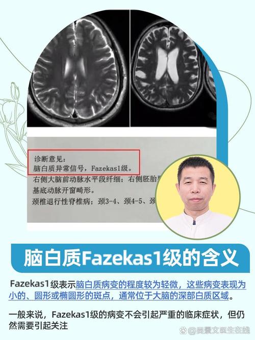 脑白质病和脑梗的区别