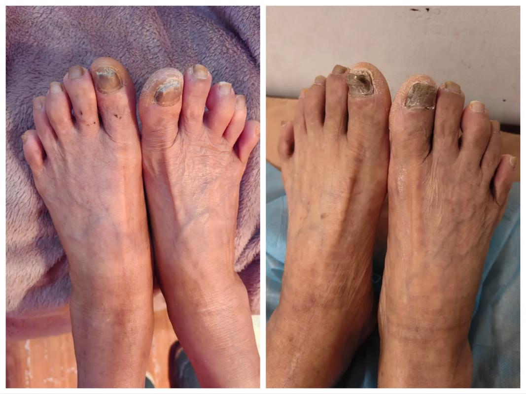 一天泡两次脚会风湿吗